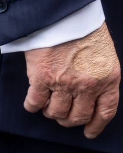 Trump Has Chronic Venous Insufficiency: What This Means